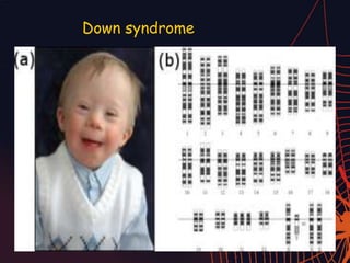 Down syndrome
 