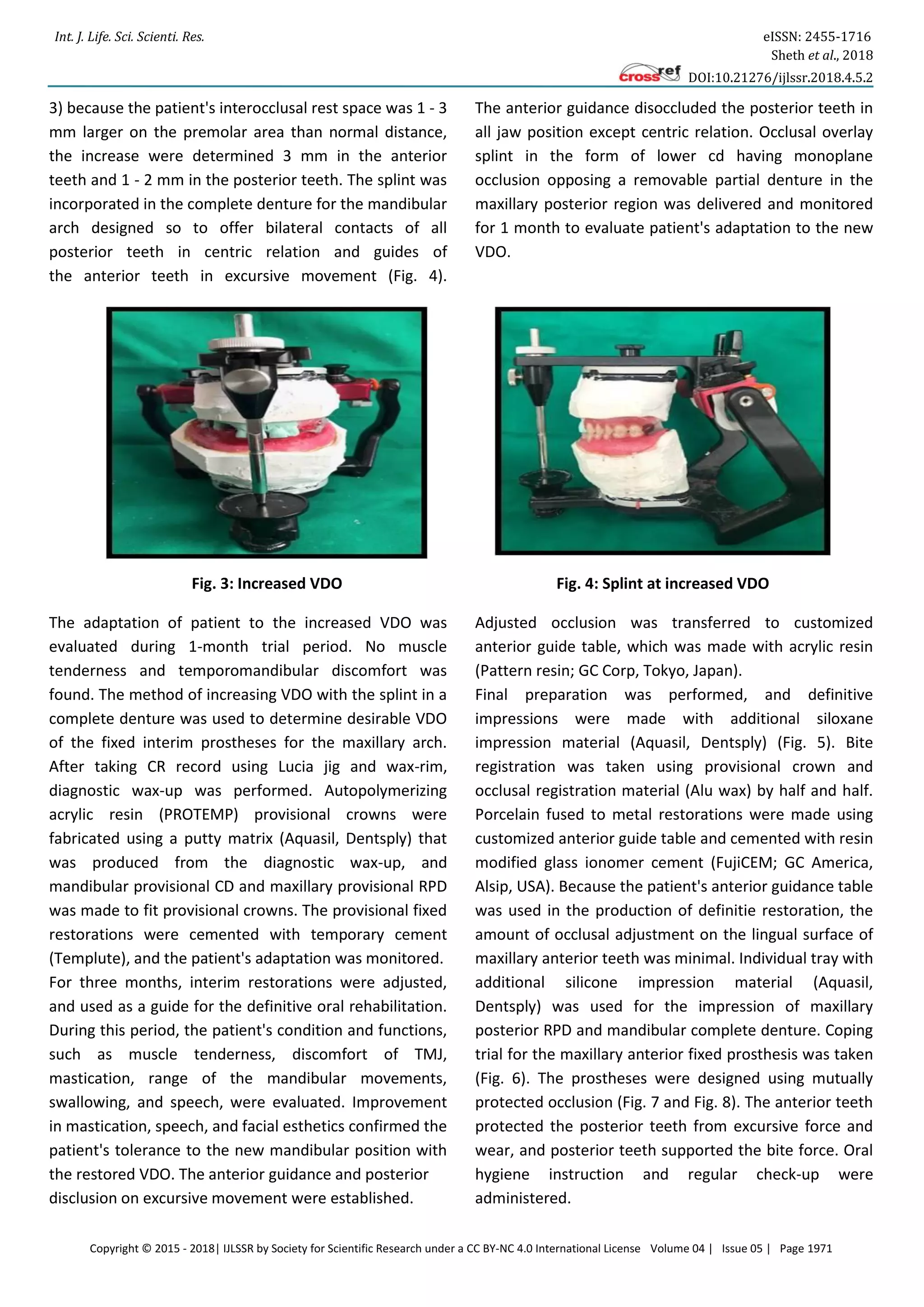 Int. J. Life. Sci. Scienti. Res. eISSN: 2455-1716
Sheth et al., 2018
DOI:10.21276/ijlssr.2018.4.5.2
Copyright © 2015 - 2018| IJLSSR by Society for Scientific Research under a CC BY-NC 4.0 International License Volume 04 | Issue 05 | Page 1971
3) because the patient's interocclusal rest space was 1 - 3
mm larger on the premolar area than normal distance,
the increase were determined 3 mm in the anterior
teeth and 1 - 2 mm in the posterior teeth. The splint was
incorporated in the complete denture for the mandibular
arch designed so to offer bilateral contacts of all
posterior teeth in centric relation and guides of
the anterior teeth in excursive movement (Fig. 4).
The anterior guidance disoccluded the posterior teeth in
all jaw position except centric relation. Occlusal overlay
splint in the form of lower cd having monoplane
occlusion opposing a removable partial denture in the
maxillary posterior region was delivered and monitored
for 1 month to evaluate patient's adaptation to the new
VDO.
Fig. 3: Increased VDO Fig. 4: Splint at increased VDO
The adaptation of patient to the increased VDO was
evaluated during 1-month trial period. No muscle
tenderness and temporomandibular discomfort was
found. The method of increasing VDO with the splint in a
complete denture was used to determine desirable VDO
of the fixed interim prostheses for the maxillary arch.
After taking CR record using Lucia jig and wax-rim,
diagnostic wax-up was performed. Autopolymerizing
acrylic resin (PROTEMP) provisional crowns were
fabricated using a putty matrix (Aquasil, Dentsply) that
was produced from the diagnostic wax-up, and
mandibular provisional CD and maxillary provisional RPD
was made to fit provisional crowns. The provisional fixed
restorations were cemented with temporary cement
(Templute), and the patient's adaptation was monitored.
For three months, interim restorations were adjusted,
and used as a guide for the definitive oral rehabilitation.
During this period, the patient's condition and functions,
such as muscle tenderness, discomfort of TMJ,
mastication, range of the mandibular movements,
swallowing, and speech, were evaluated. Improvement
in mastication, speech, and facial esthetics confirmed the
patient's tolerance to the new mandibular position with
the restored VDO. The anterior guidance and posterior
disclusion on excursive movement were established.
Adjusted occlusion was transferred to customized
anterior guide table, which was made with acrylic resin
(Pattern resin; GC Corp, Tokyo, Japan).
Final preparation was performed, and definitive
impressions were made with additional siloxane
impression material (Aquasil, Dentsply) (Fig. 5). Bite
registration was taken using provisional crown and
occlusal registration material (Alu wax) by half and half.
Porcelain fused to metal restorations were made using
customized anterior guide table and cemented with resin
modified glass ionomer cement (FujiCEM; GC America,
Alsip, USA). Because the patient's anterior guidance table
was used in the production of definitie restoration, the
amount of occlusal adjustment on the lingual surface of
maxillary anterior teeth was minimal. Individual tray with
additional silicone impression material (Aquasil,
Dentsply) was used for the impression of maxillary
posterior RPD and mandibular complete denture. Coping
trial for the maxillary anterior fixed prosthesis was taken
(Fig. 6). The prostheses were designed using mutually
protected occlusion (Fig. 7 and Fig. 8). The anterior teeth
protected the posterior teeth from excursive force and
wear, and posterior teeth supported the bite force. Oral
hygiene instruction and regular check-up were
administered.
 
