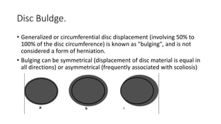 Disc Buldge.
• Generalized or circumferential disc displacement (involving 50% to
100% of the disc circumference) is known as "bulging", and is not
considered a form of herniation.
• Bulging can be symmetrical (displacement of disc material is equal in
all directions) or asymmetrical (frequently associated with scoliosis)
 