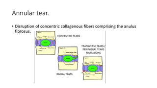 Annular tear.
• Disruption of concentric collagenous fibers comprising the anulus
fibrosus.
 