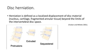 Disc herniation.
• Herniation is defined as a localized displacement of disc material
(nucleus, cartilage, fragmented annular tissue) beyond the limits of
the intervertebral disc space.
(Fardon and Milette 2001).
 
