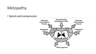 Melopathy.
• Spinal cord compression.
 