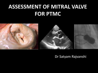 ASSESSMENT OF MITRAL VALVE
FOR PTMC
Dr Satyam Rajvanshi
 
