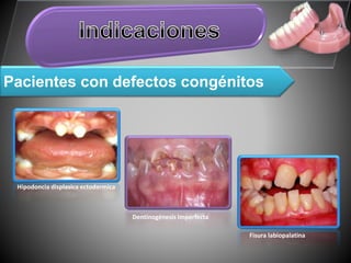 Pacientes con defectos congénitos
Hipodoncia displasica ectodermica
Dentinogénesis Imperfecta
Fisura labiopalatina
 