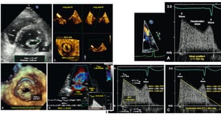 Echocardiography of Mitral Valve : Surgeons perspective | PDF