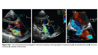 Echocardiography of Mitral Valve : Surgeons perspective | PDF
