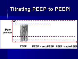 Titrating PEEP to PEEPiTitrating PEEP to PEEPi
 
