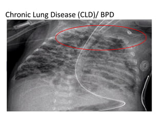 Chronic Lung Disease (CLD)/ BPD
Fetal Lung
Development
Postnatal Lung Growth And
Development
Pulmonary
Outcome
Initiation
Of
Breathing
Mechanical
Ventilation
Oxygen Infection
Preterm
Labour
Preterm
Delivery
CANNALICULAR STAGE
SACCULAR STAGE
ALVEOLAR STAGE
 