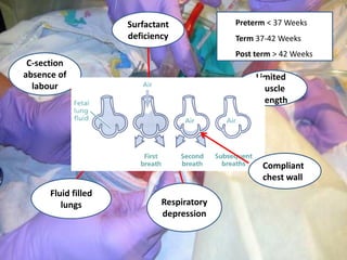 Respiratory
depression
Surfactant
deficiency
Fluid filled
lungs
C-section
absence of
labour
Limited
muscle
strength
Limited ability to
establish FRC
Compliant
chest wall
Preterm ˂ 37 Weeks
Term 37-42 Weeks
Post term ˃ 42 Weeks
 