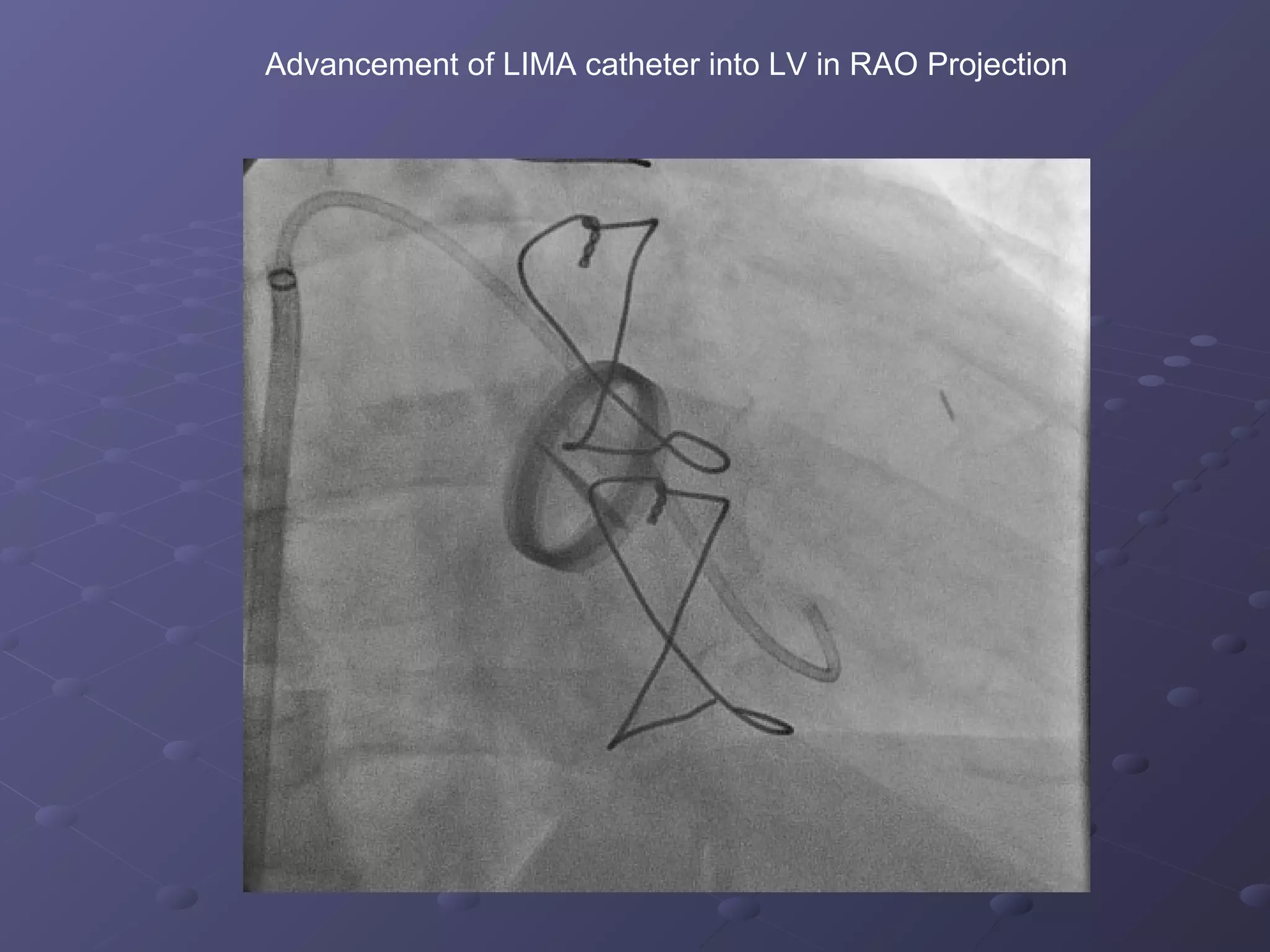 Mv perivalvular leak | PPT
