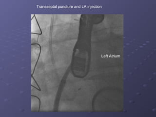 Mv perivalvular leak | PPT