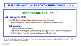 Claude EUGÈNE
MALADIE VASCULAIRE PORTO-SINUSOIDALE (MVPS)
Manifestations (2/5) 1)
c) Imagerie (1/3)
La MVPS est souvent confondue avec une cirrhose
Cependant l'aspect nodulaire fréquent dans la cirrhose est plus rare (16%)
Échographie
. Surface normale ou nodulaire.
. Dilatation du tronc porte, collatérales, parois épaissies (> 3 mm) hyperéchogènes.
. Splénomégalie (souvent plus marquée que dans la cirrhose).
12
1) De Gottardi A, Sempoux C, Berzigotti A. Porto-sinusoidal vascular disorder. J Hepatol 2022;77(4):1124-1135.
(Accès libre sur internet, iconographie).
 