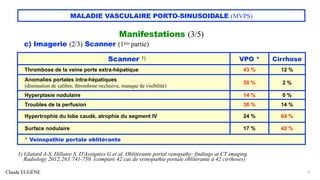 Claude EUGÈNE
MALADIE VASCULAIRE PORTO-SINUSOIDALE (MVPS)
Manifestations (3/5)
c) Imagerie (2/3) Scanner (1ère partie)
13
1) Glatard A-S, Hillaire S, D'Assignies G et al. Oblitérante portal venopathy: findings at CT imaging.
Radiology 2012;263:741-750. (compare 42 cas de veinopathie portale oblitérante à 42 cirrhoses)
Scanner 1) VPO * Cirrhose
Thrombose de la veine porte extra-hépatique 43 % 12 %
Anomalies portales intra-hépatiques
(diminution de calibre, thrombose occlusive, manque de visibilité)
58 % 2 %
Hyperplasie nodulaire 14 % 0 %
Troubles de la perfusion 36 % 14 %
Hypertrophie du lobe caudé, atrophie du segment IV 24 % 64 %
Surface nodulaire 17 % 42 %
* Veinopathie portale oblitérante
 