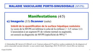 Claude EUGÈNE
MALADIE VASCULAIRE PORTO-SINUSOIDALE (MVPS)
Manifestations (4/5)
c) Imagerie (3/3) Scanner (suite)
Intérêt de la quantification de la surface hépatique nodulaire
Le score de la MVPS est inférieur à celui de la cirrhose ( < 2,5 versus 3,1)
L'association à un segment IV de volume normal ou augmenté,
est associé au diagnostic de MVPS (spécificité de 90%) 1)
14
1) Valainathan SR, Sartoris R, Elkrief L et al. Contrast-enhanced CT and liver surface nodularity for the diagnosis of
porto-sinusoidal vascular disorder: a case-control study. Hepatology 2022;76:418-422. (Accès libre sur internet).
 