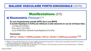 Claude EUGÈNE
MALADIE VASCULAIRE PORTO-SINUSOIDALE (MVPS)
Manifestations (5/5)
d) Élastométrie (Fibroscan*) 1)
En cas d'hypertension portale (HTP) due à une MVPS,
la dureté hépatique (7,9 kPa) est inférieure à celle observée en cas de cirrhoses liées:
a) à l'alcool (33,8 kPa),
b) au virus C (18,2 kPa),
c) à la NASH (Non Alcoholic SteatoHepatitis) (33,6 kPa).
Conclusion
HTP et < 10 kPa => MVPS probable / HTP et > 20 kPa => MVPS peu probable 1) 2)
15
1) Elkrief L, Lazareth M, Chevret S et al. Liver stiffness by transient elastometry to detect porto-sinusoidal vascular liver disease
with portal hypertension. Hepatology 2021;74(1):364-378.
2) De Franchis R, Bosch J, Gardia-Tsao G, Reiberger T et al. Baveno VII. Renewing consensus in portal hypertension. J Hepatol
2022;76(4):959-974. (Accès libre sur internet).
 