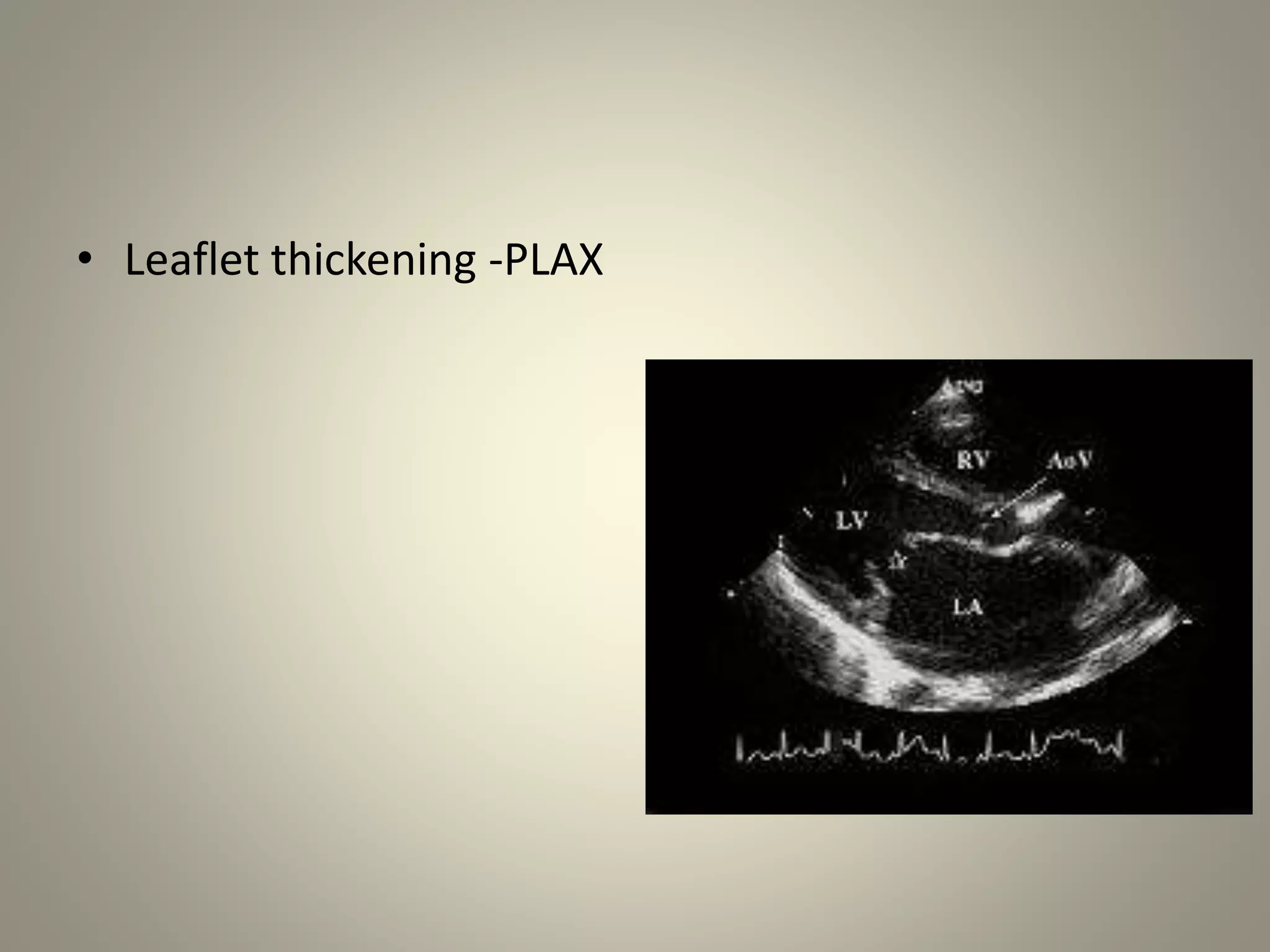 • Leaflet thickening -PLAX
 