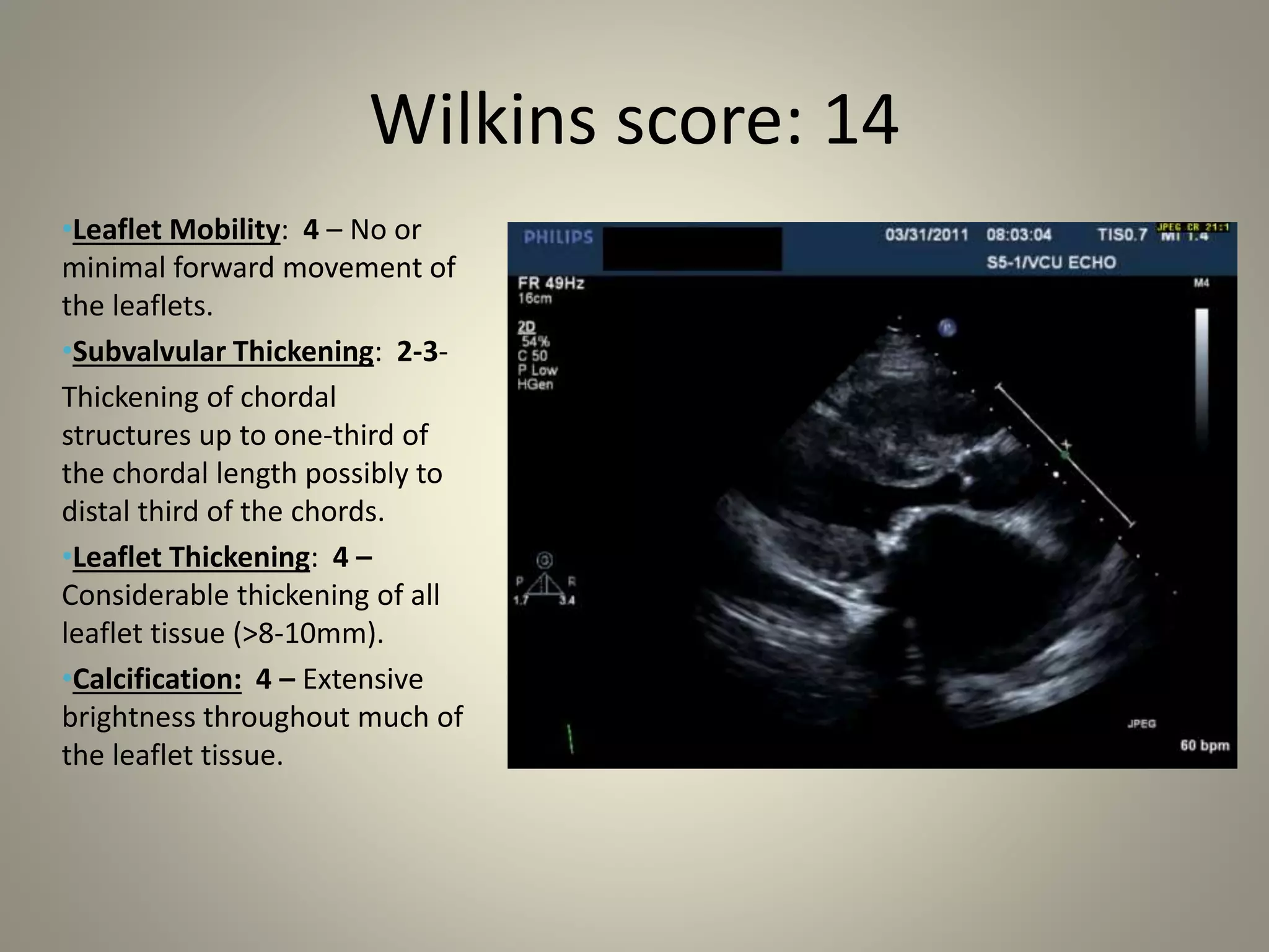 •Leaflet Mobility: 4 – No or
minimal forward movement of
the leaflets.
•Subvalvular Thickening: 2-3-
Thickening of chordal
structures up to one-third of
the chordal length possibly to
distal third of the chords.
•Leaflet Thickening: 4 –
Considerable thickening of all
leaflet tissue (>8-10mm).
•Calcification: 4 – Extensive
brightness throughout much of
the leaflet tissue.
Wilkins score: 14
 