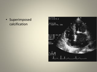 Mitral valve scoring before BMV | PPTX