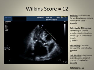 Mitral valve scoring before BMV | PPTX