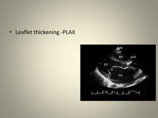 Mitral valve scoring before BMV