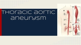 Thoracic aortic
aneurysm
 