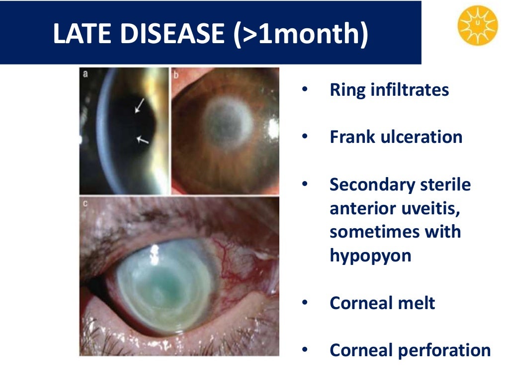 Acanthamoeba keratitis