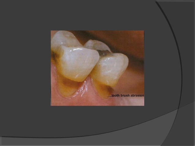 eroding translucent tooth eroding translucent tooth