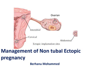 Management of Non tubal Ectopic
pregnancy
Berhanu Mohammed
Ovarian
 