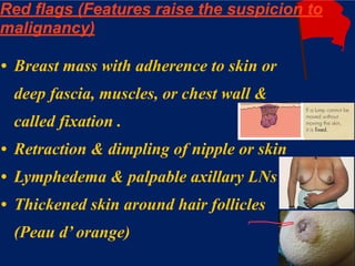 Mx of breast cancer | PDF