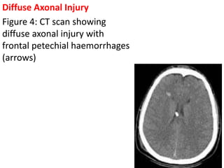 Management Of Head Injury PK anesthesia.pptx