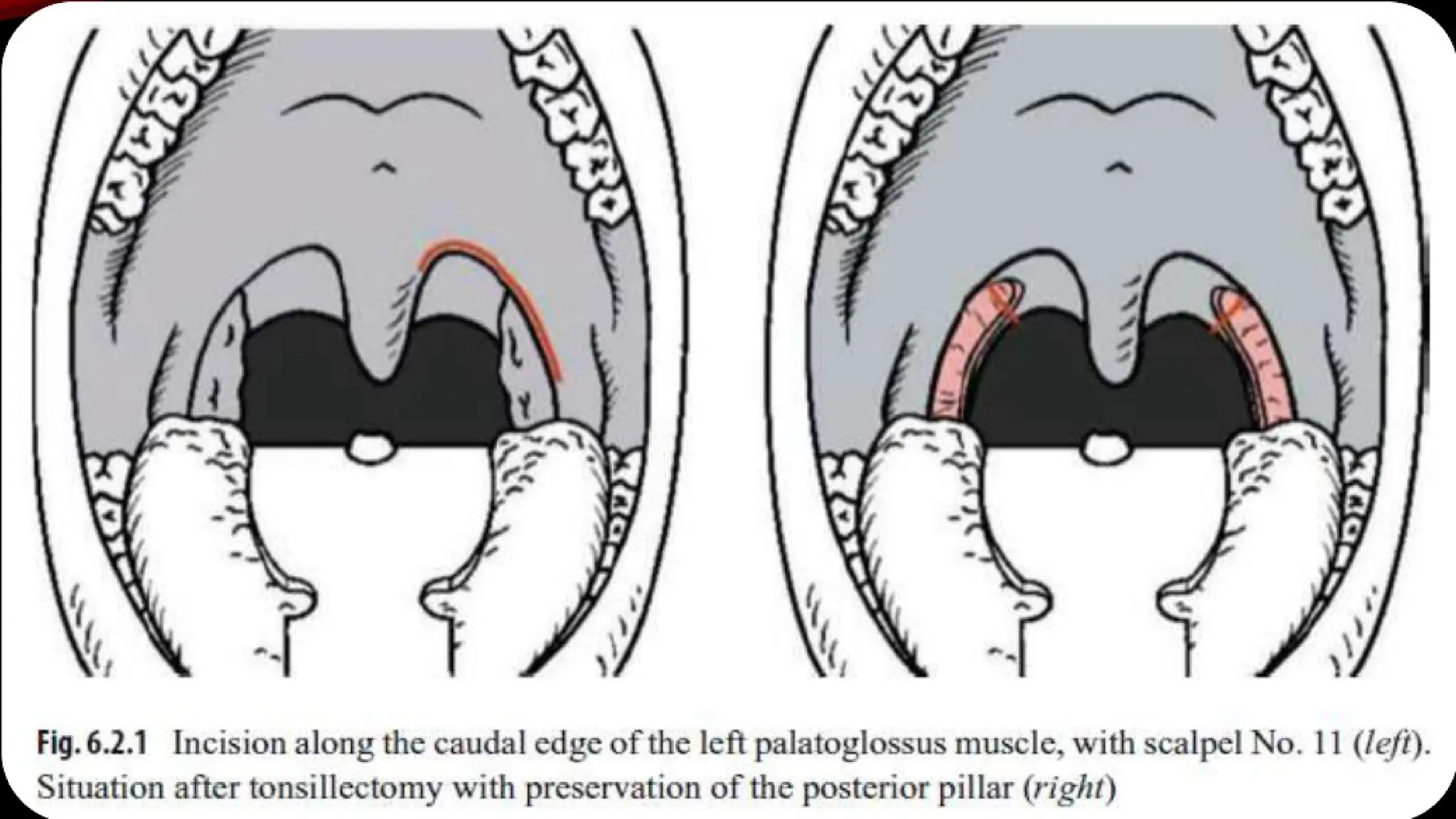 Management Of Obstructive Sleep Apnea Pptx