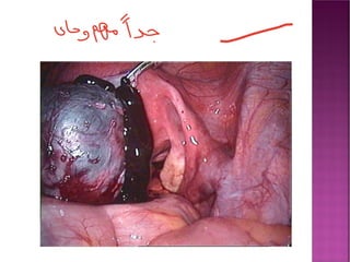 Management of ovarian cyst.pdf