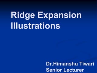 Dr.Himanshu Tiwari
Senior Lecturer
Ridge Expansion
Illustrations
 