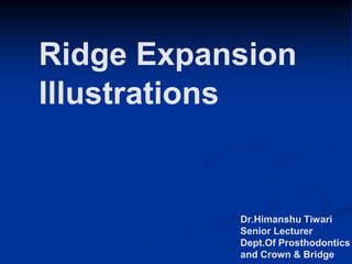 Dr.Himanshu Tiwari
Senior Lecturer
Dept.Of Prosthodontics
and Crown & Bridge
Ridge Expansion
Illustrations
 