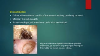Myiasis in Ear Nose Throat and HNS .pptx
