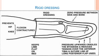 RIGID DRESSING
 