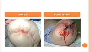 Infection Wound necrosis
 