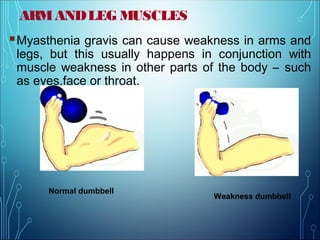 ARMANDLEG MUSCLES
Myasthenia gravis can cause weakness in arms and
legs, but this usually happens in conjunction with
muscle weakness in other parts of the body – such
as eyes,face or throat.
Normal dumbbell
Weakness dumbbell
 