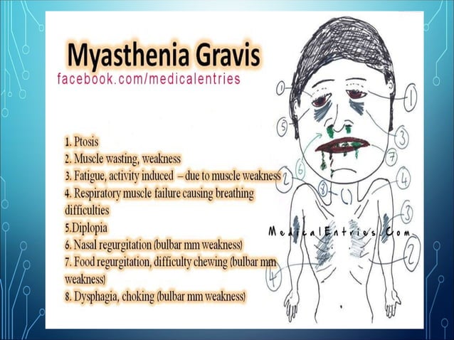 Myasthenia Gravis Myasthenia Gravis