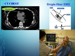 CT CHEST
Thymom
a
Single-fiber EMG
 