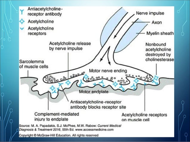 myasthenia gravis