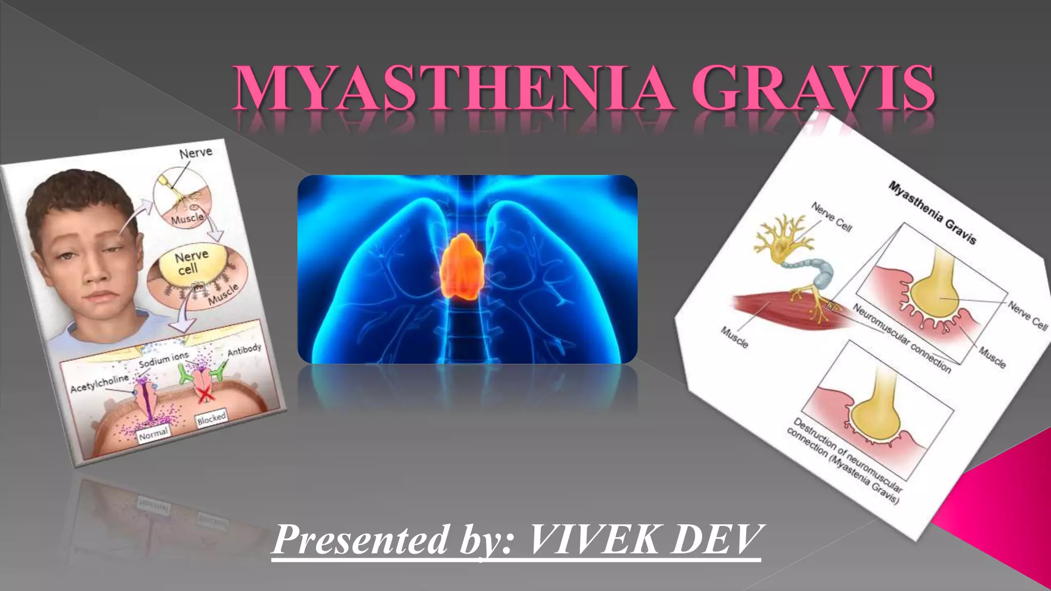 Myasthenia gravis | PPTX