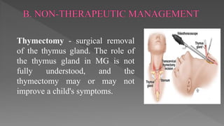 Thymectomy - surgical removal
of the thymus gland. The role of
the thymus gland in MG is not
fully understood, and the
thymectomy may or may not
improve a child's symptoms.
 