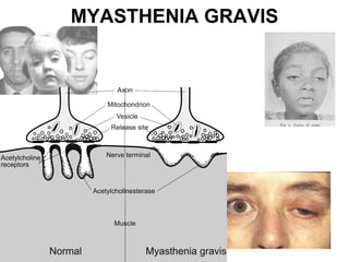 MYASTHENIA GRAVIS 