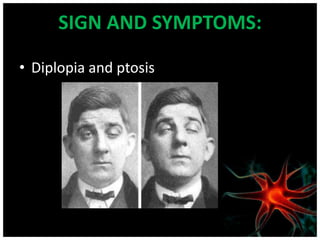 SIGN AND SYMPTOMS:

• Diplopia and ptosis
 