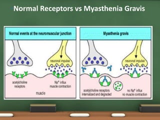 •Normal Receptors vs Myasthenia Gravis
 