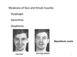 Weakness of face and throat muscles
Dysphagia
Dysarthria
Dysphonia
Myasthenic snarls
normal during attack 14
 