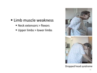  Limb muscle weakness
 Neck extensors > flexors
 Upper limbs > lower limbs
Dropped head syndrome
15
 