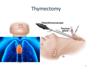 Thymectomy
45
 