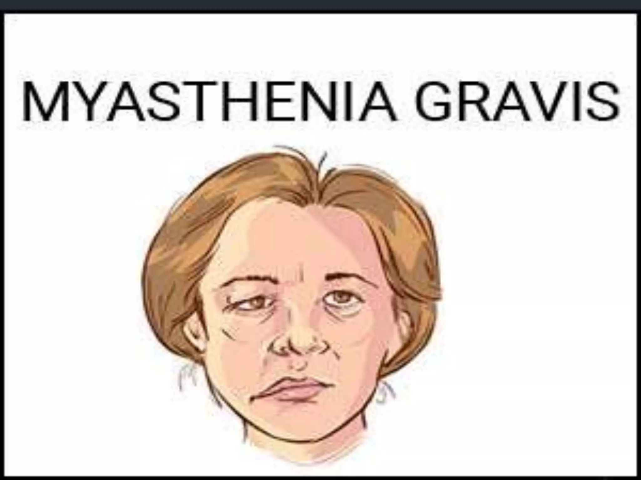 Myasthenia gravis PPT
